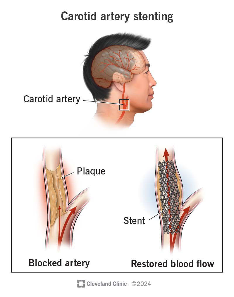 16850-carotid-artery-stenting