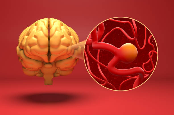 A cerebral aneurysm (also known as a brain aneurysm) is a weak or thin spot on an artery in the brain that balloons or bulges out and fills with blood. The bulging aneurysm can put pressure on the nerves or brain tissue. It may also burst or rupture, spilling blood into the surrounding tissue (called a hemorrhage).