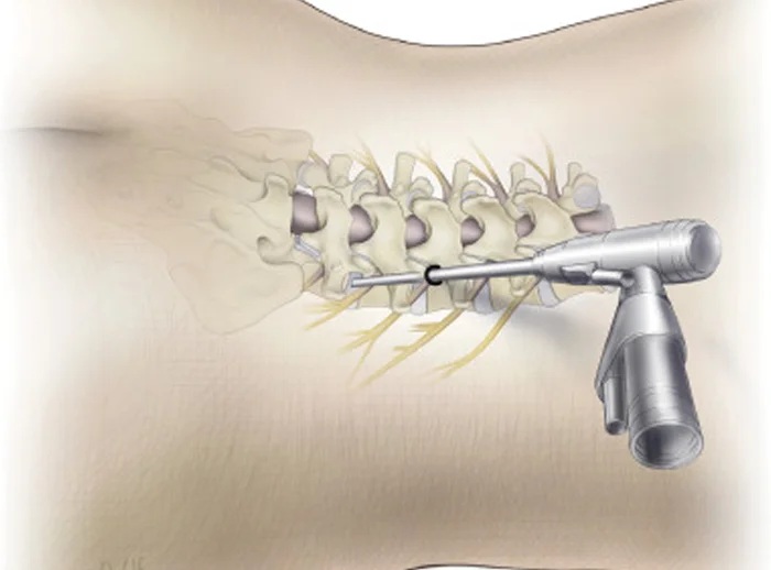 endoscopic-spine-surgery-india