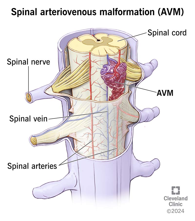 spinal-arteriovenous-malformation-avm