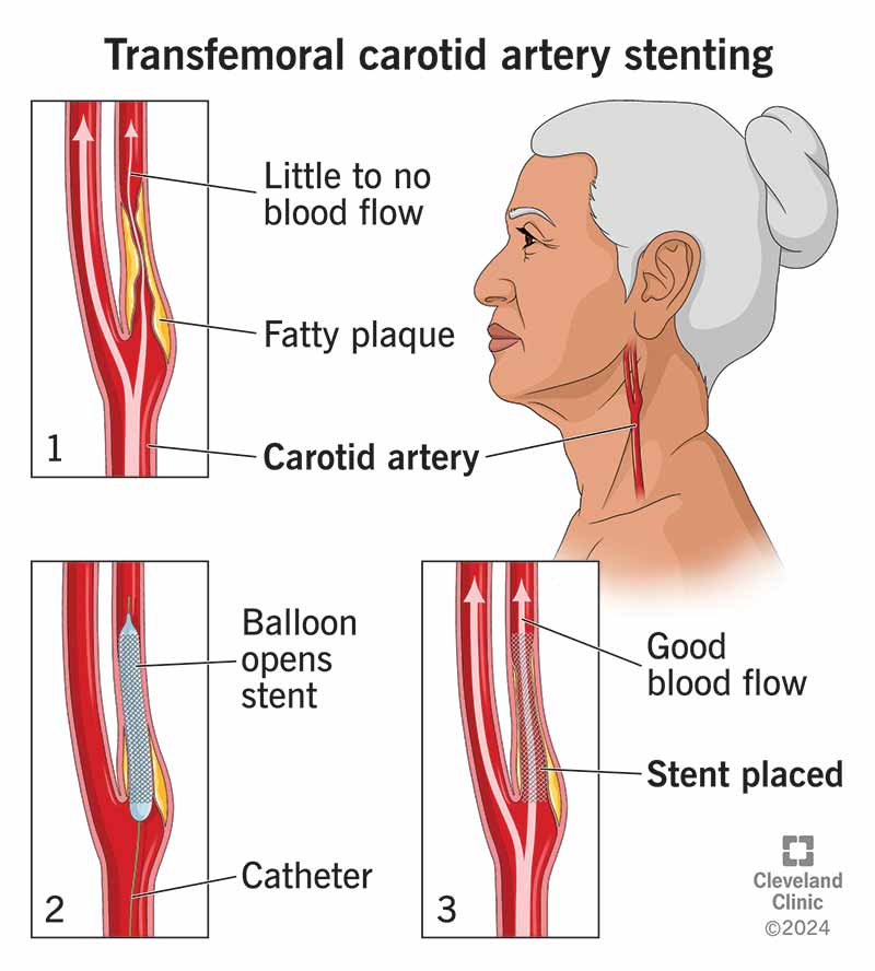 transfemoral-carotid-artery-stenting-illustration