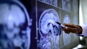 Best Hydrocephalus Treatment in Madhu Vihar