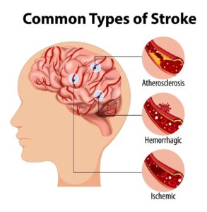Best Stroke Specialist in Patparganj